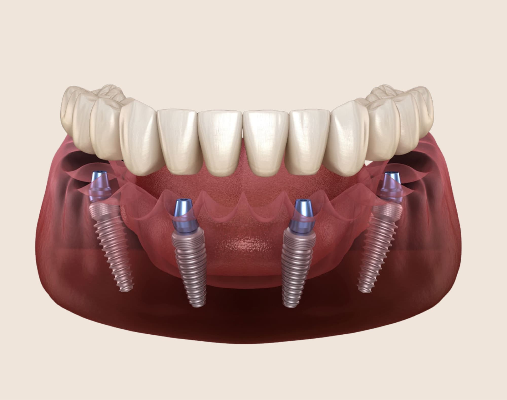 All-on-4 dental implants