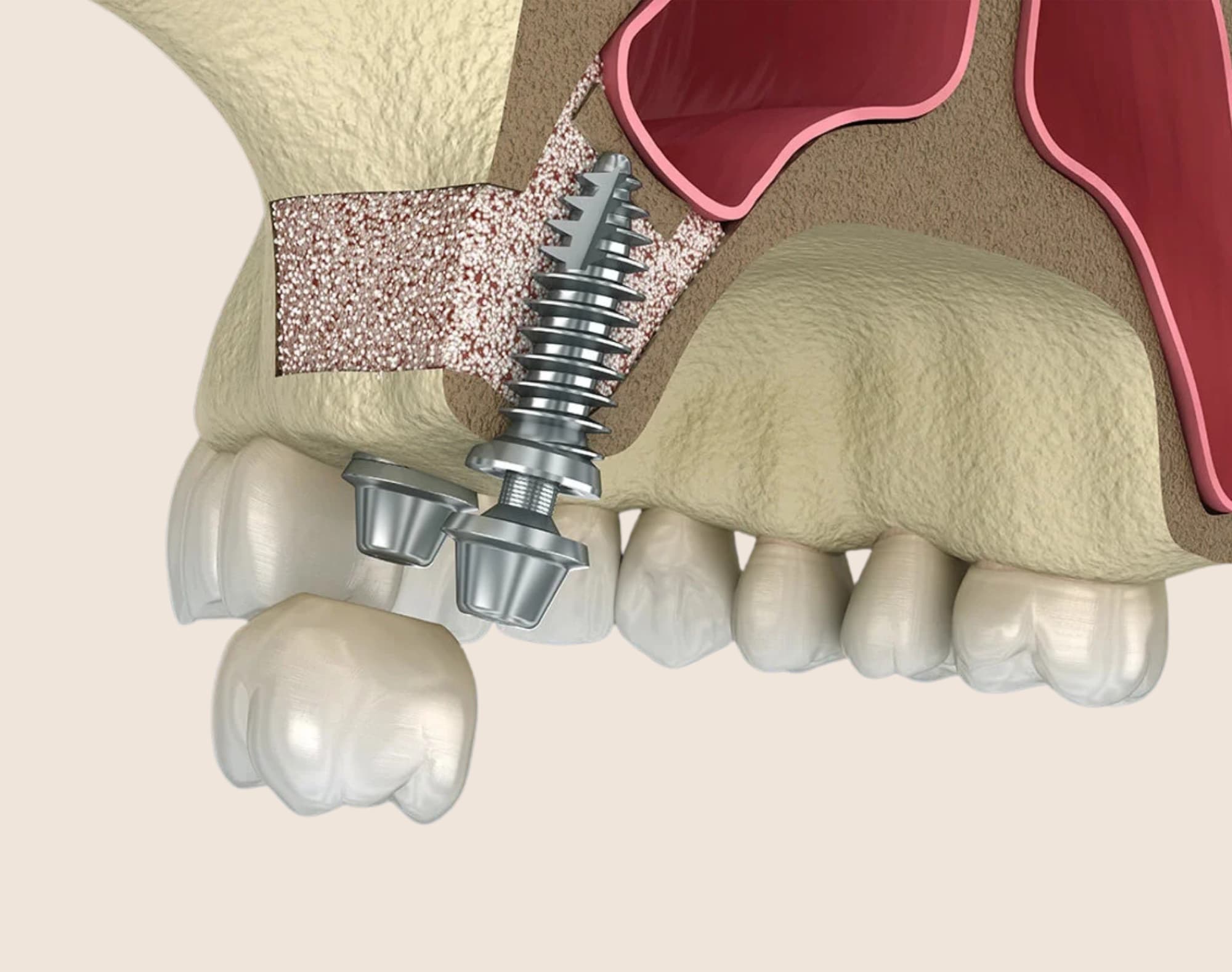 Dental bone grafting