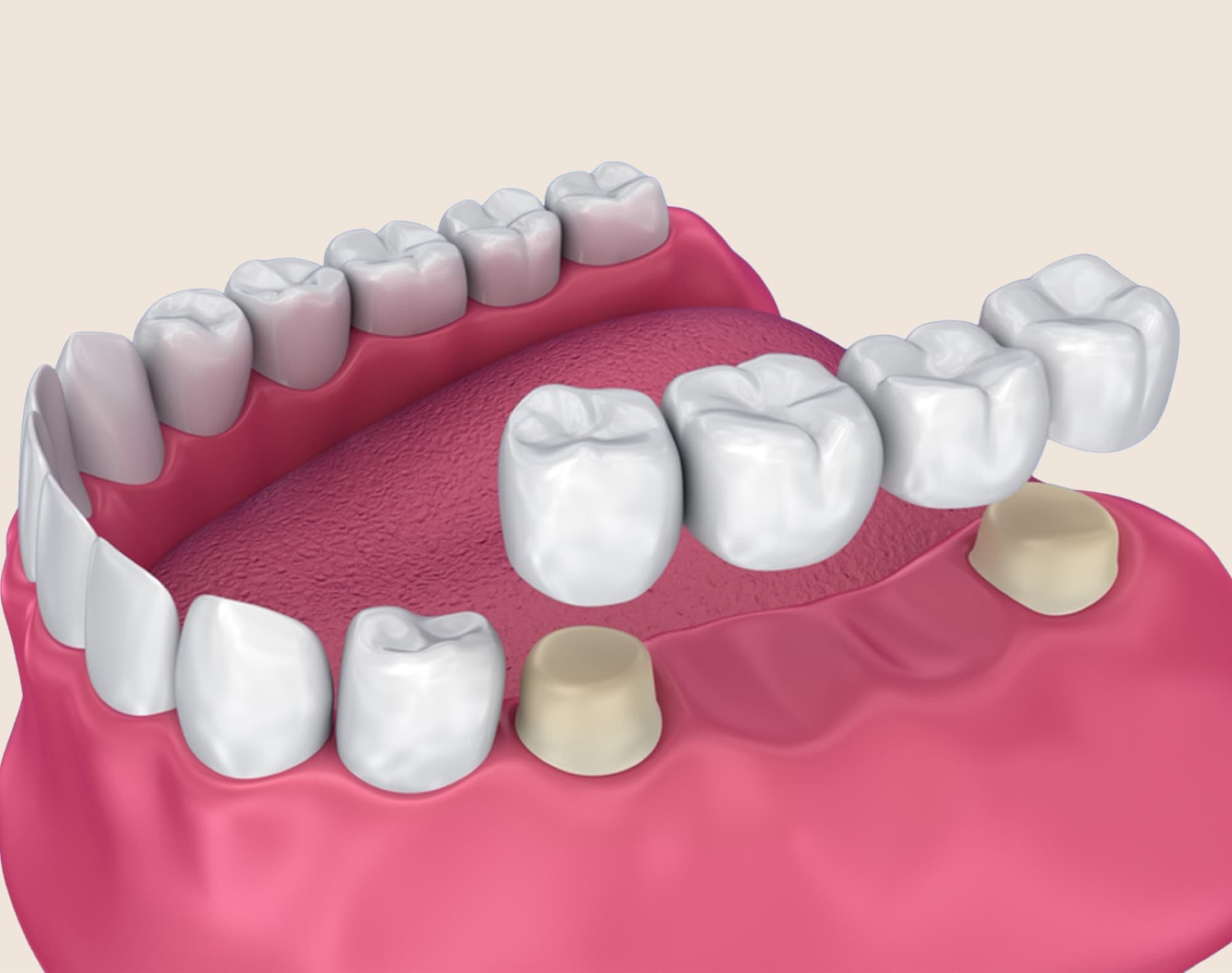 Porcelain fixed dental bridge