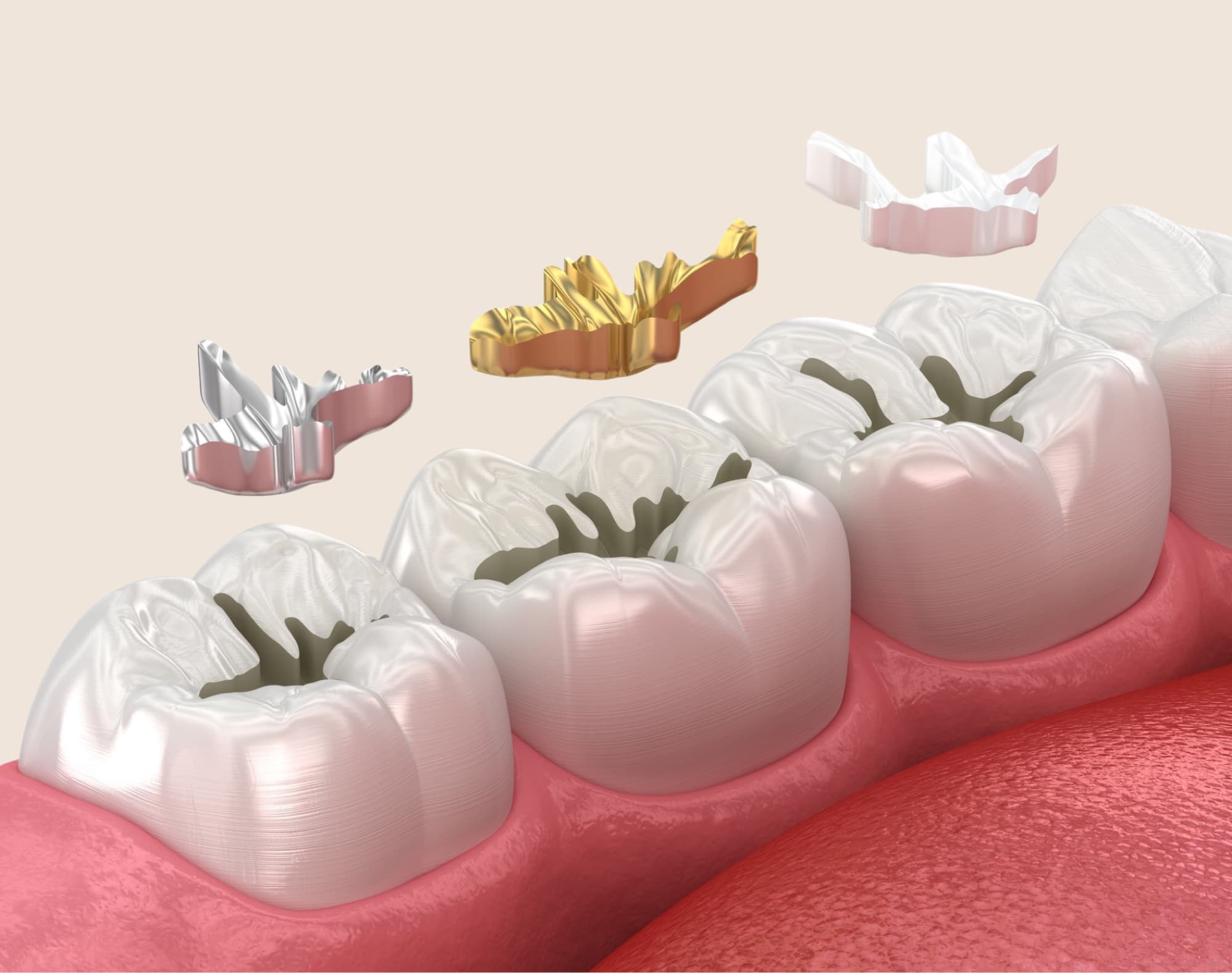 Composite dental fillings