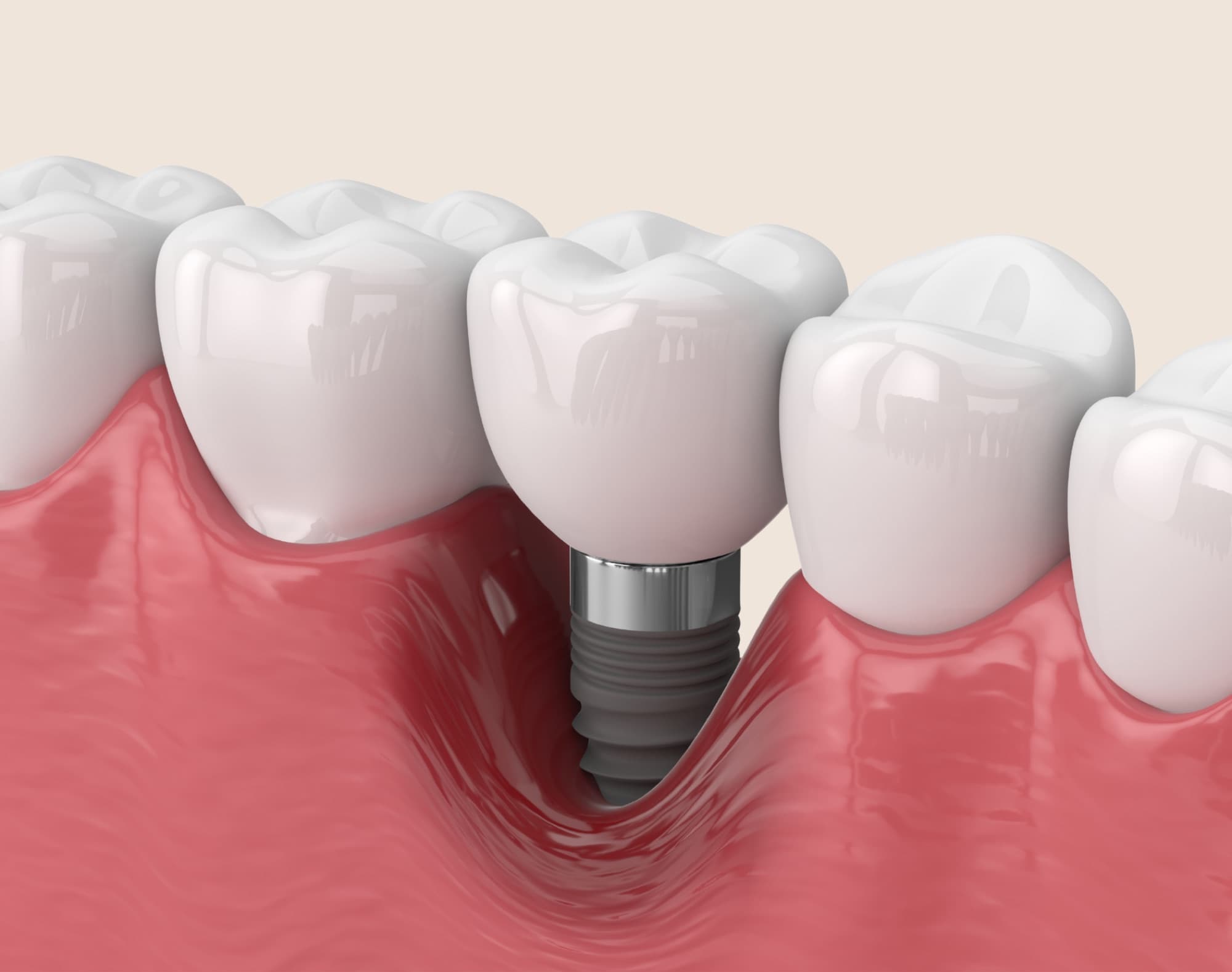 Guided dental implant surgery