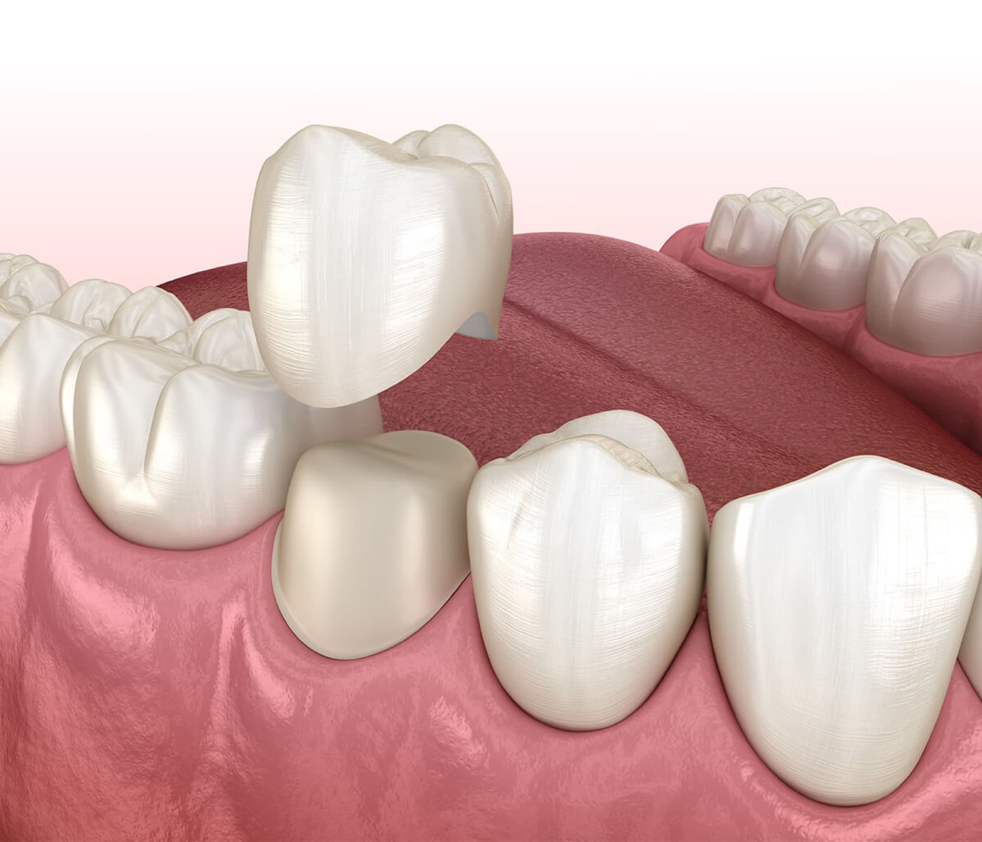 Implant crown restoration