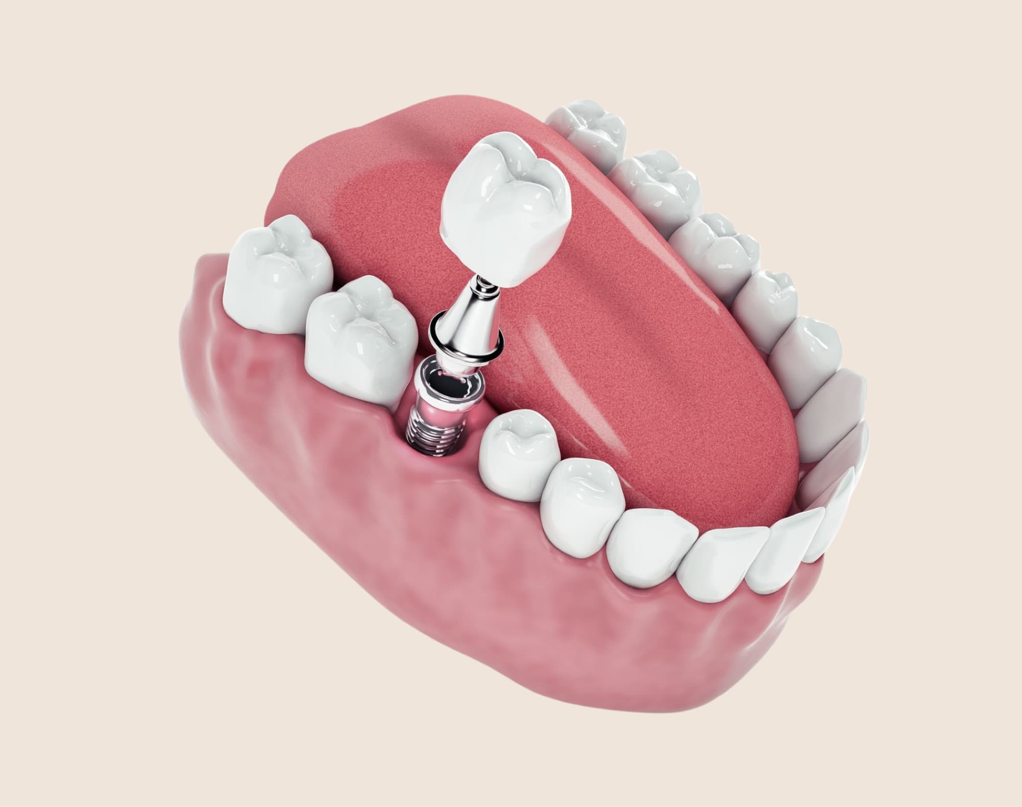 Dental implant