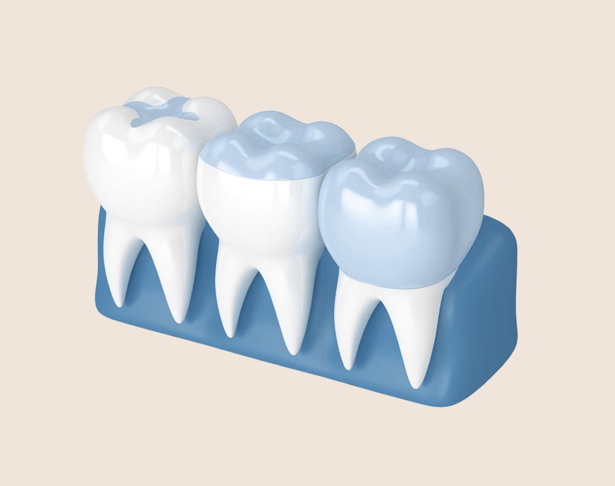 Dental crowns, inlays and onlays