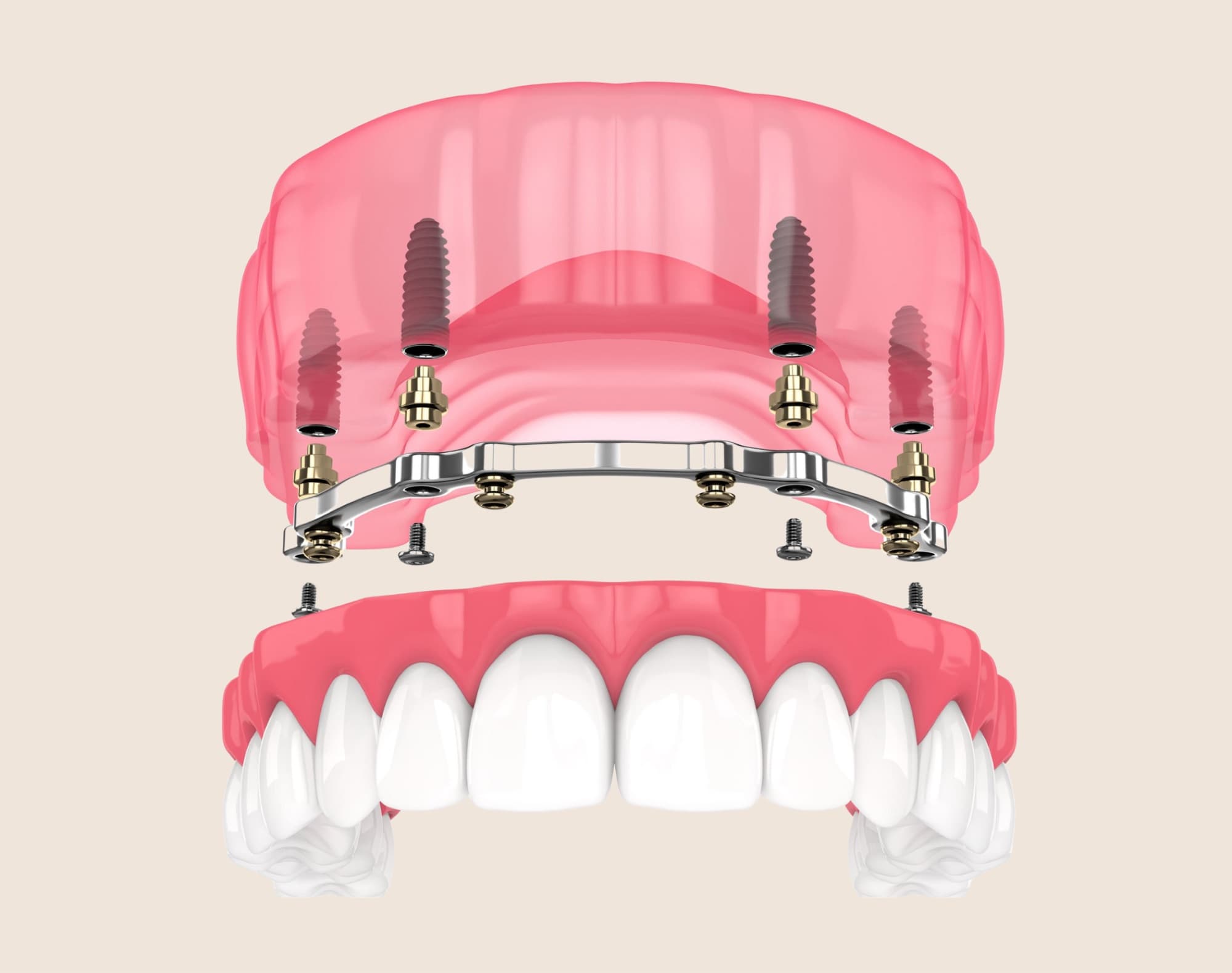 Implant-supported dentures