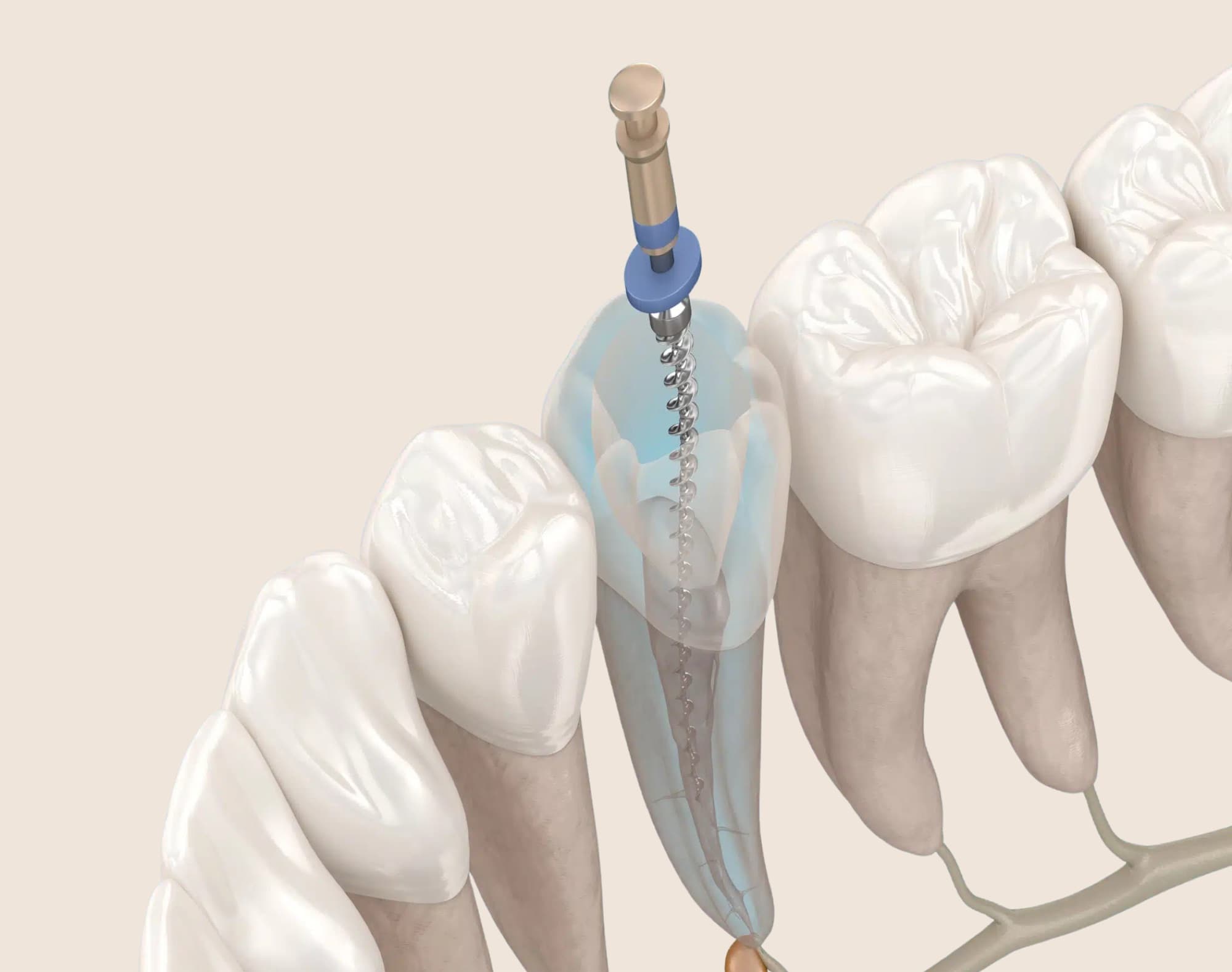 Pulp therapy / root canal retreatment