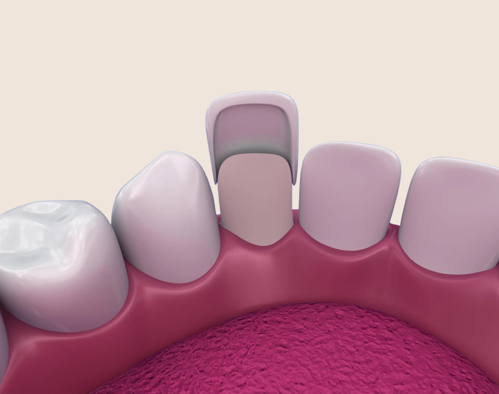 Porcelain veneers