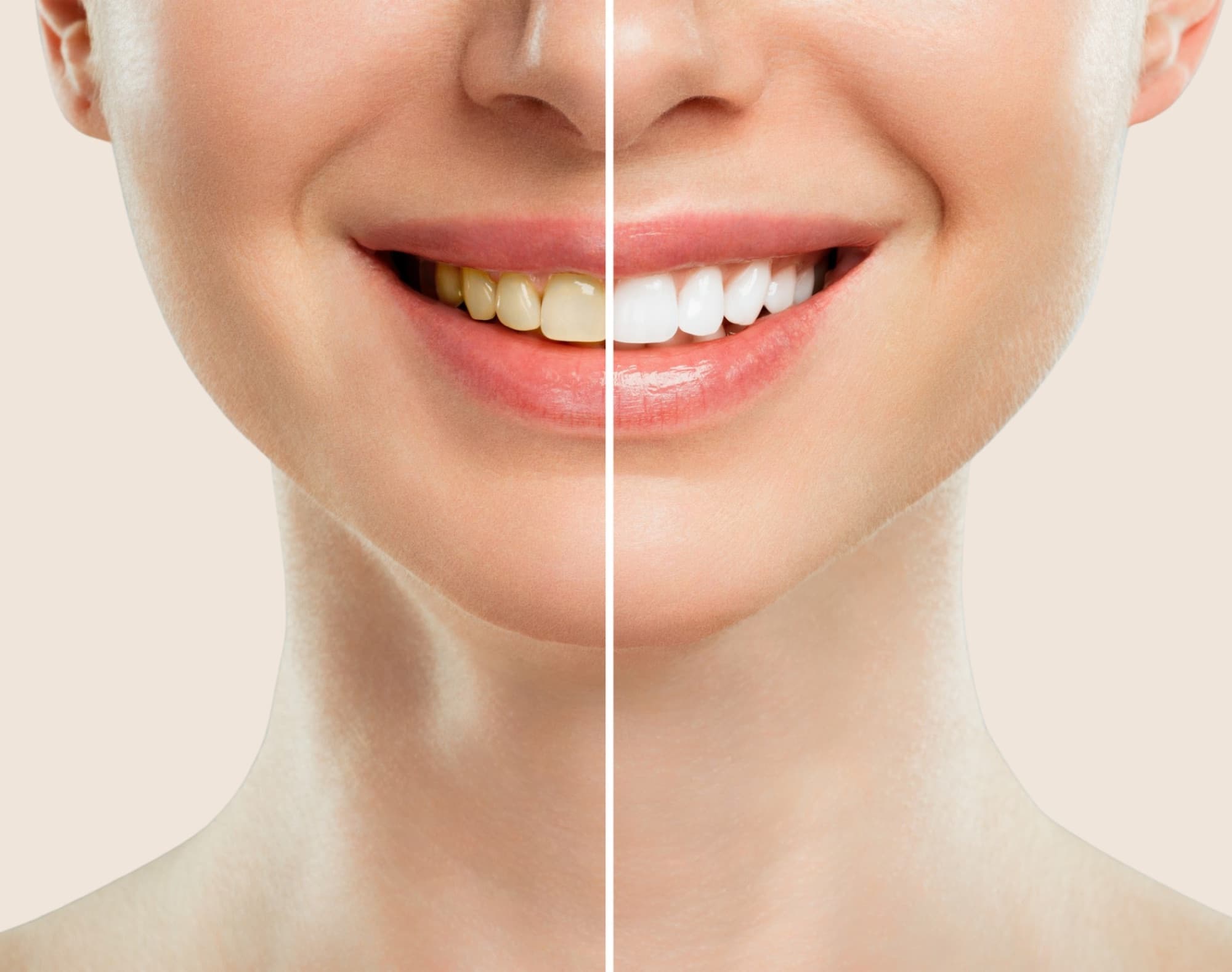 Professional teeth whitening